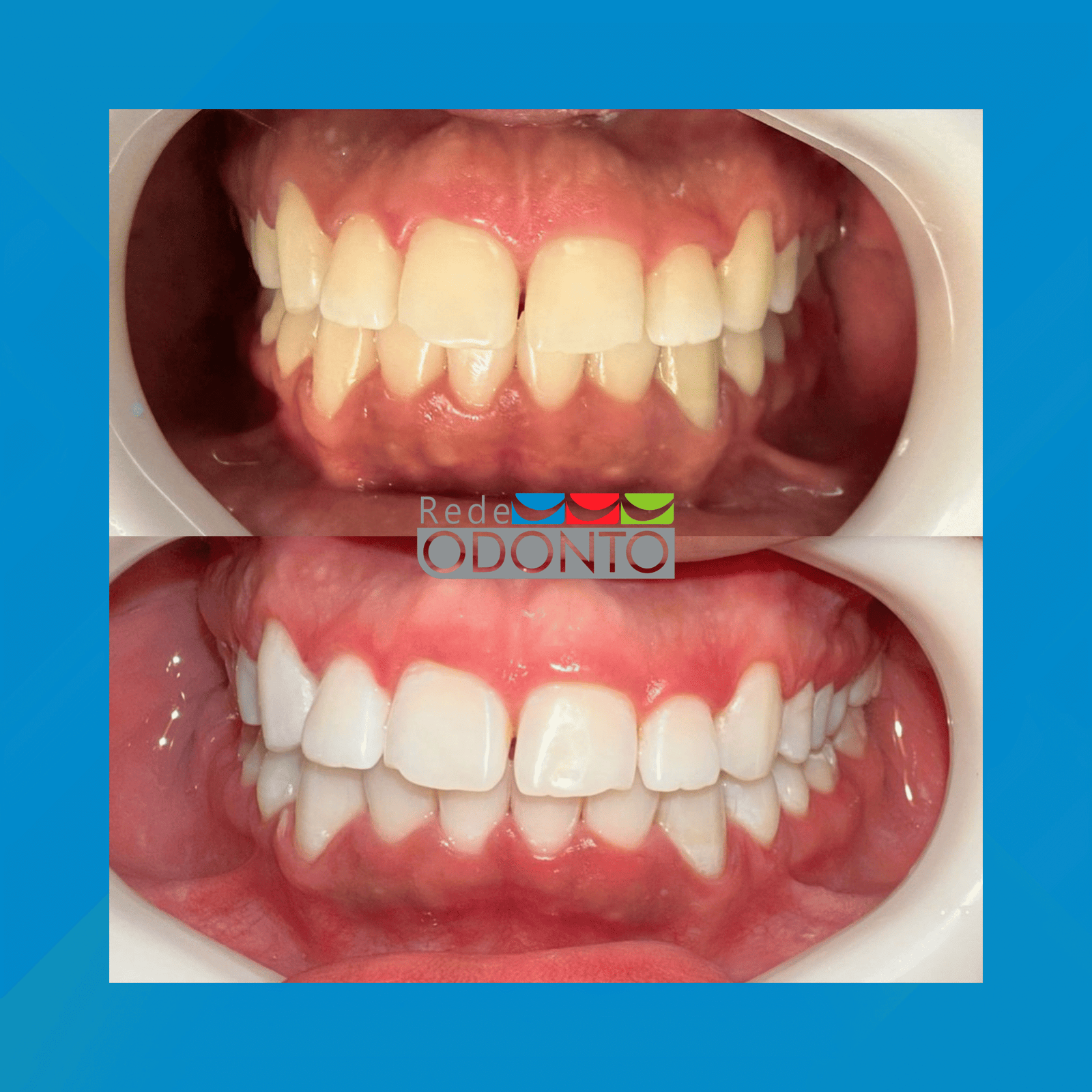 Rede Odonto Cabana. Clareamento Dental. #1.E