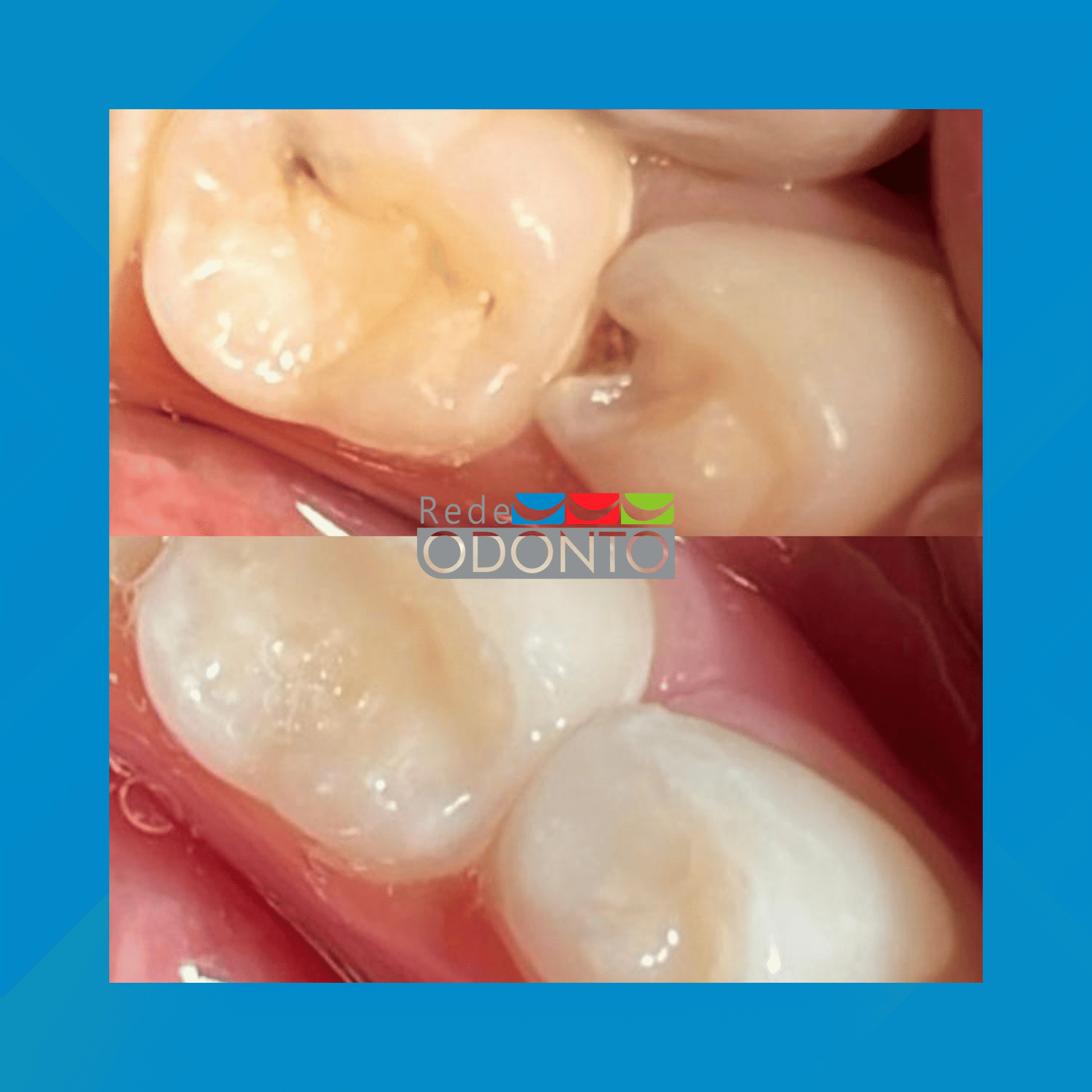 Rede Odonto Cabana. Endodontia (Canal). #1.E