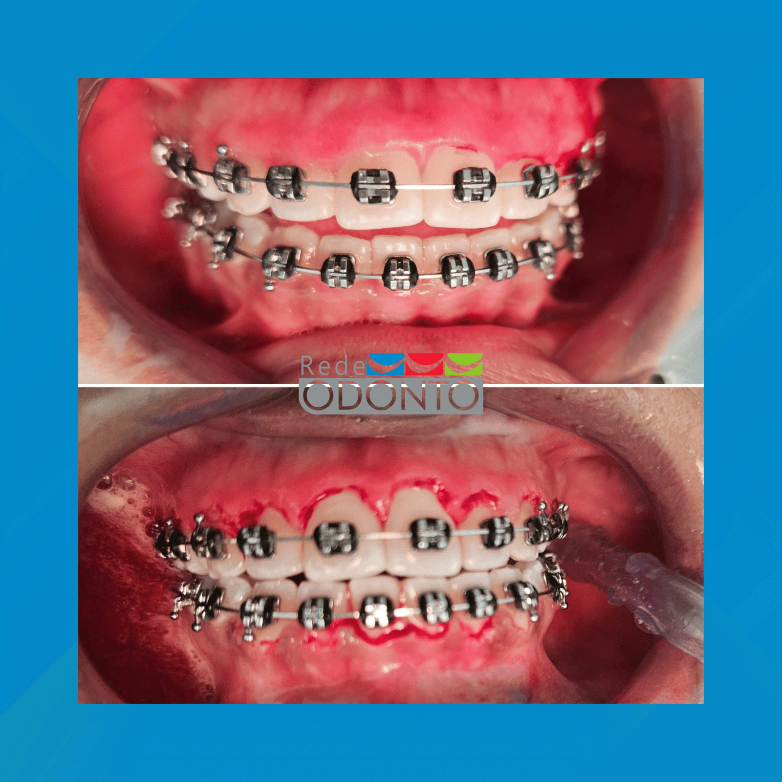 Rede Odonto Cabana. Gengivoplastia. #1.E