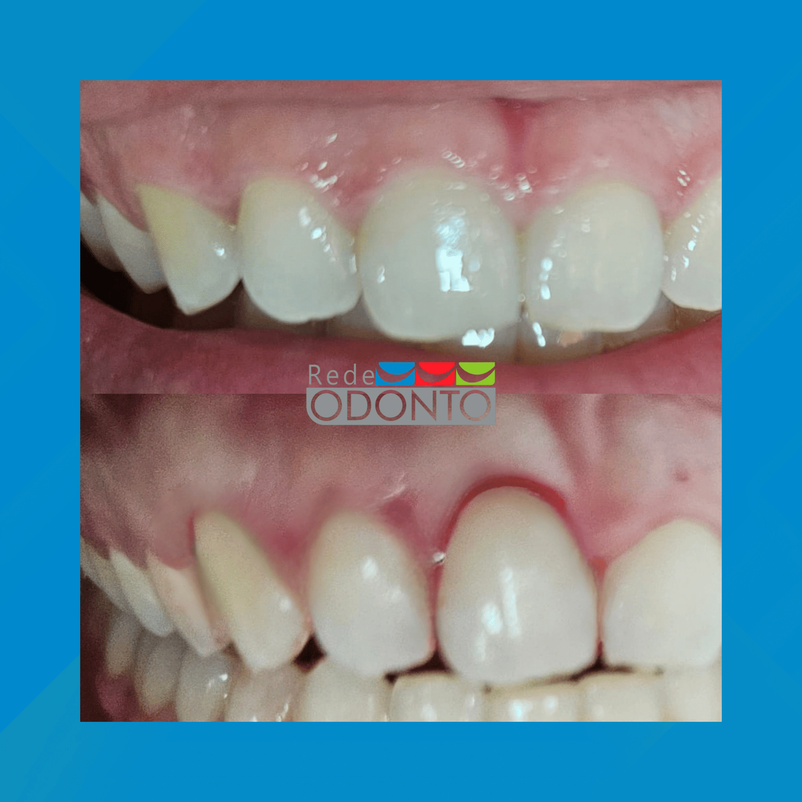 Rede Odonto Cabana. Gengivoplastia. #2.E