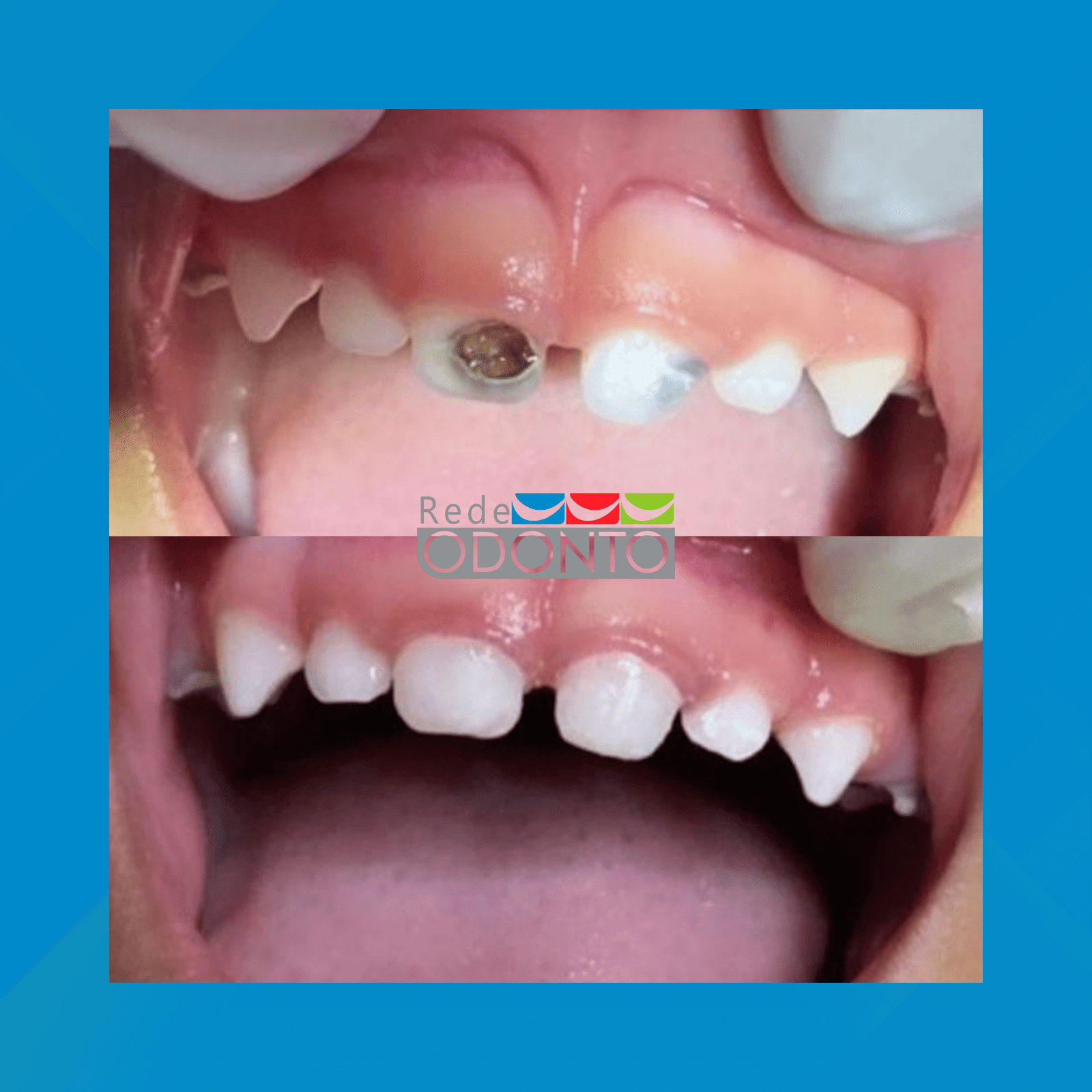 Rede Odonto Cabana. Odontopediatria. #1.E