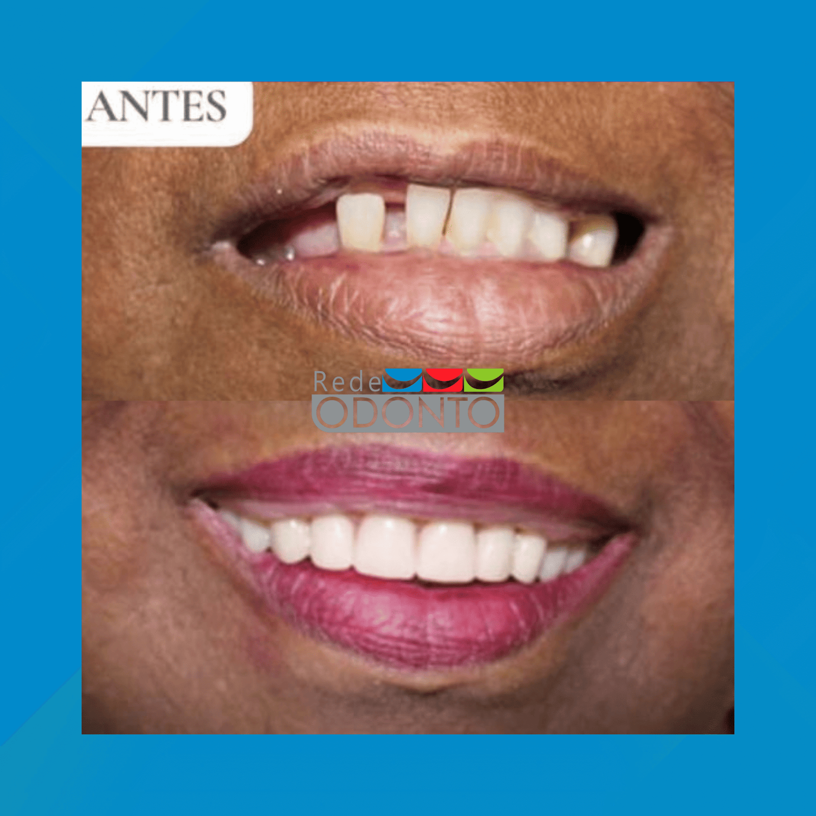 Rede Odonto Cabana. Reabilitação Oral. #1.E