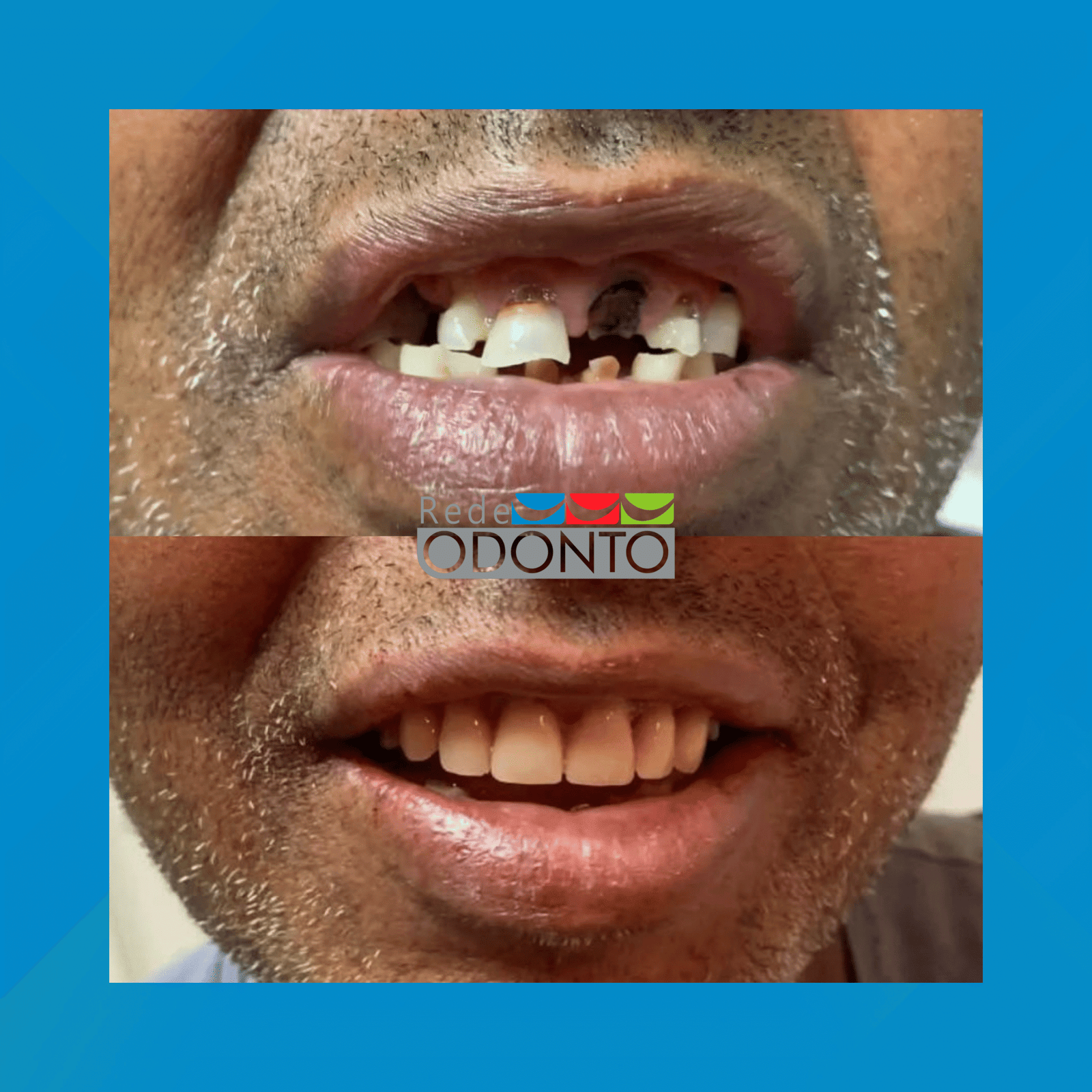 Rede Odonto Cabana. Reabilitação Oral. #3.E