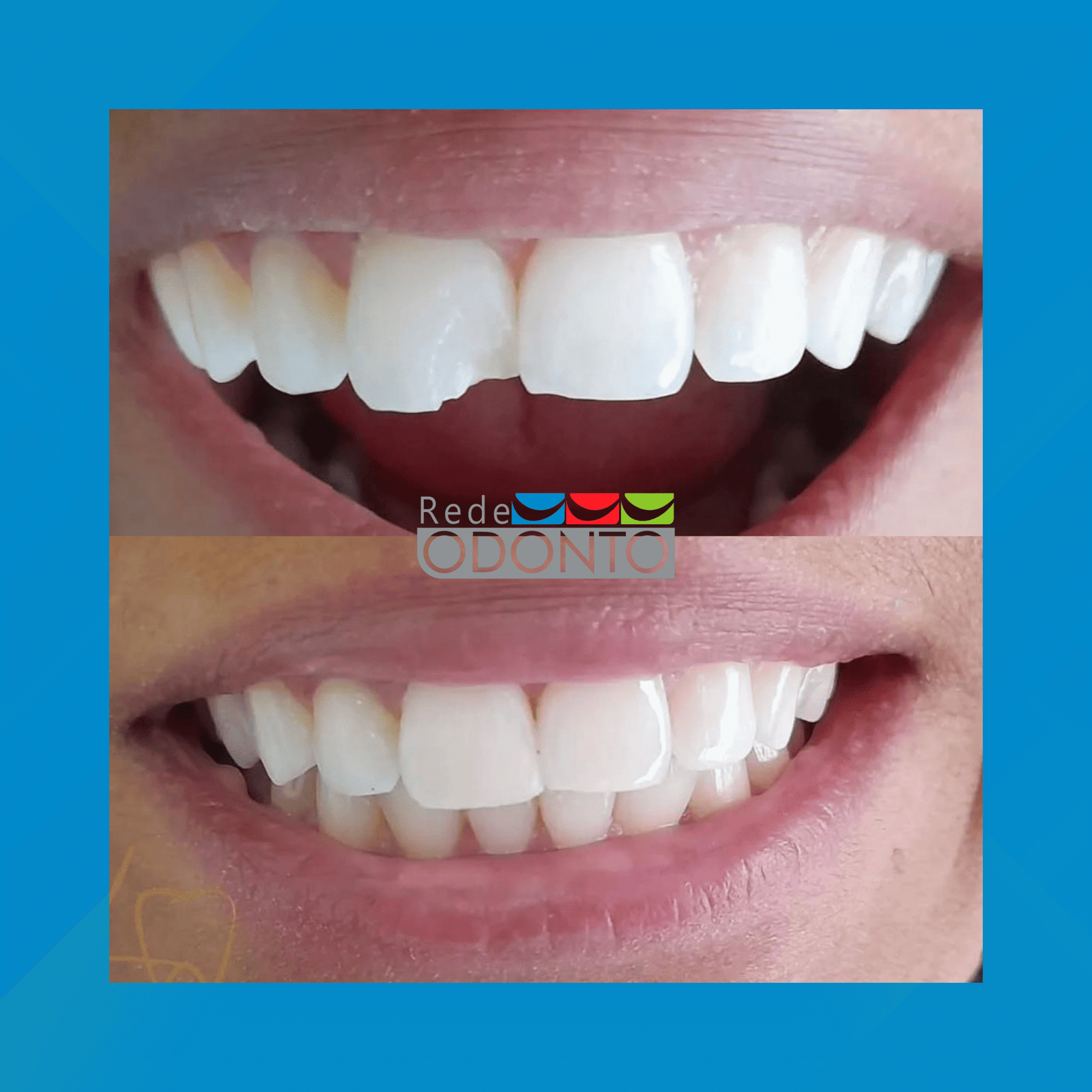 Rede Odonto Cabana. Restauração em Resina. #1.E