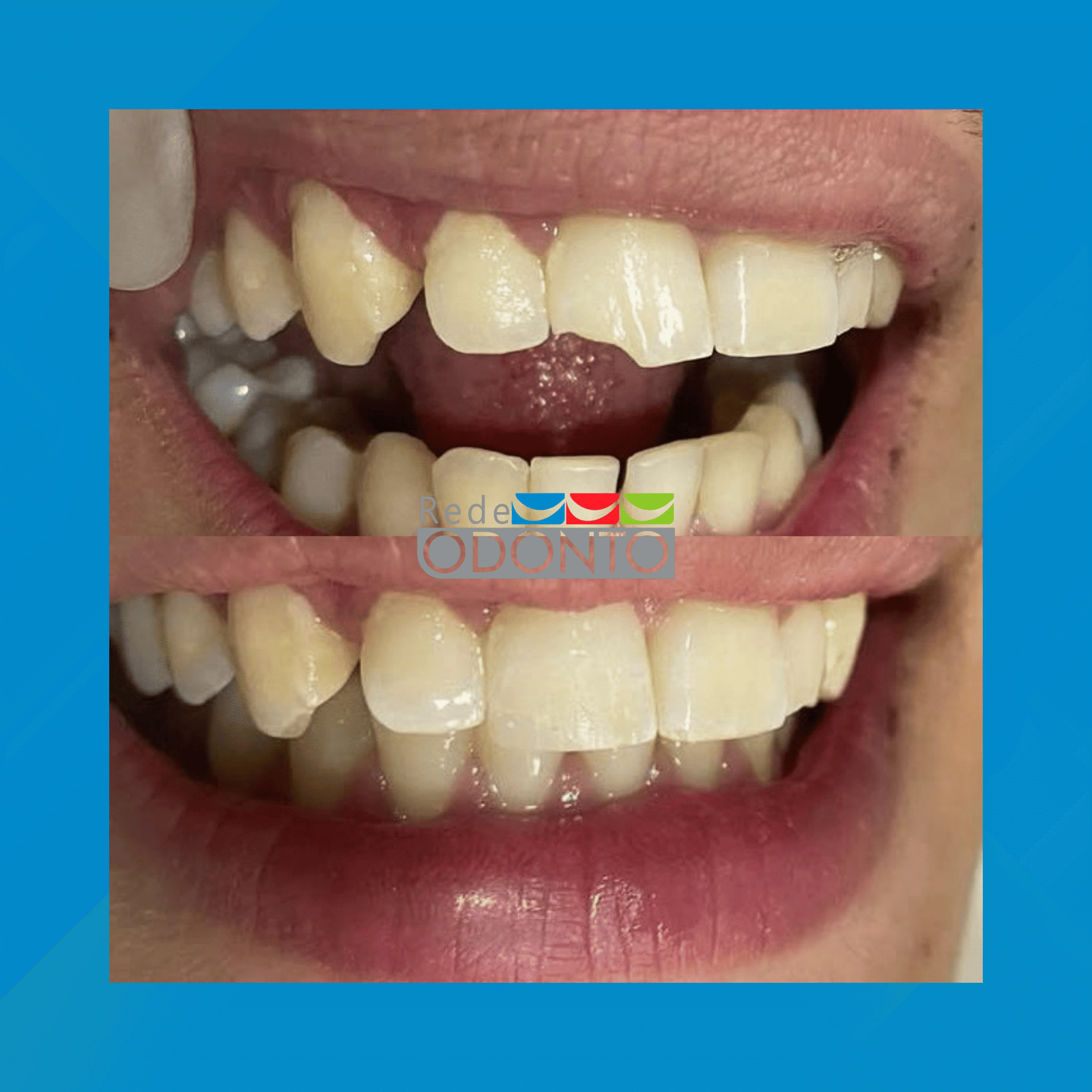 Rede Odonto Cabana. Restauração em Resina. #2.E