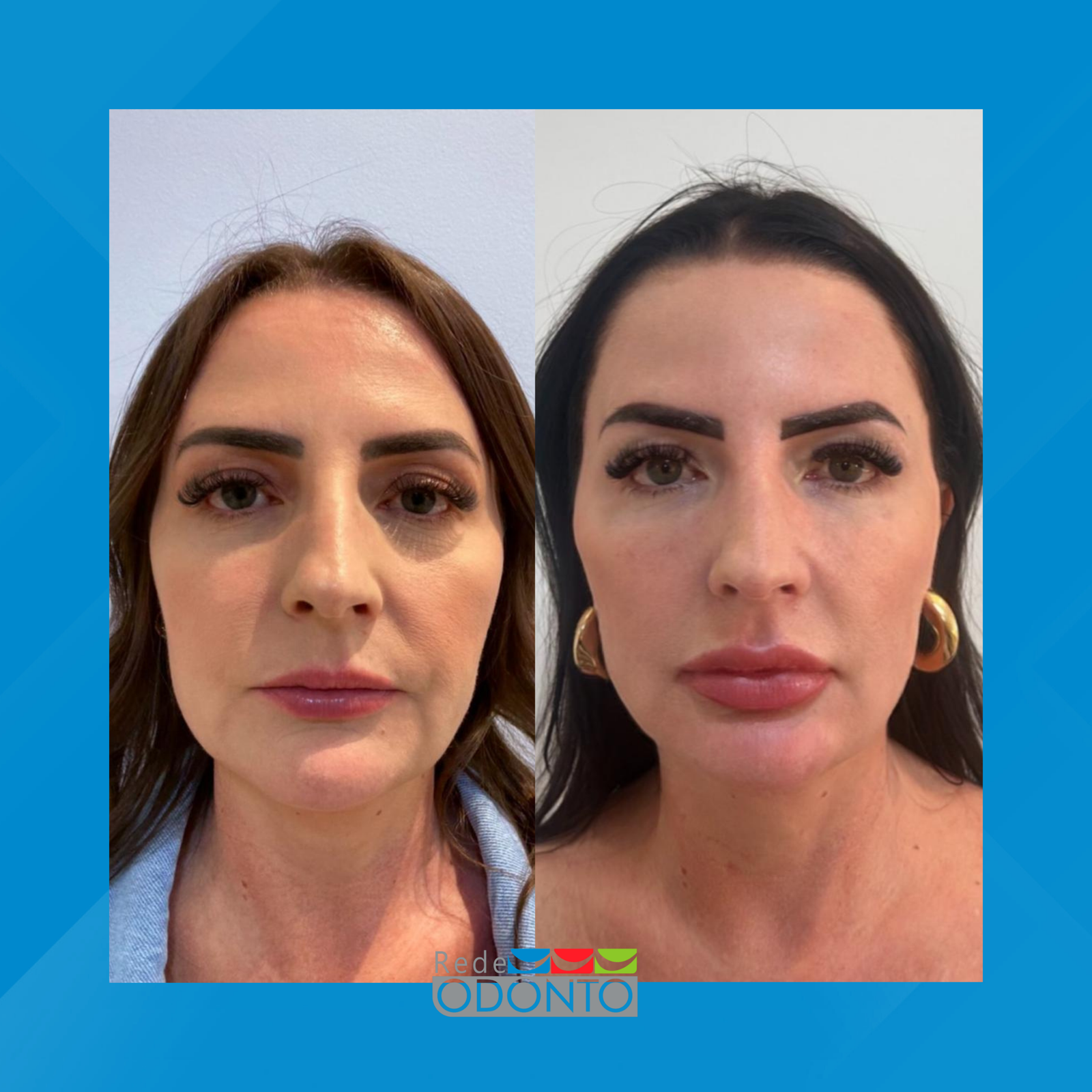 Rede Odonto Cabana. Harmonização Facial. #1.1