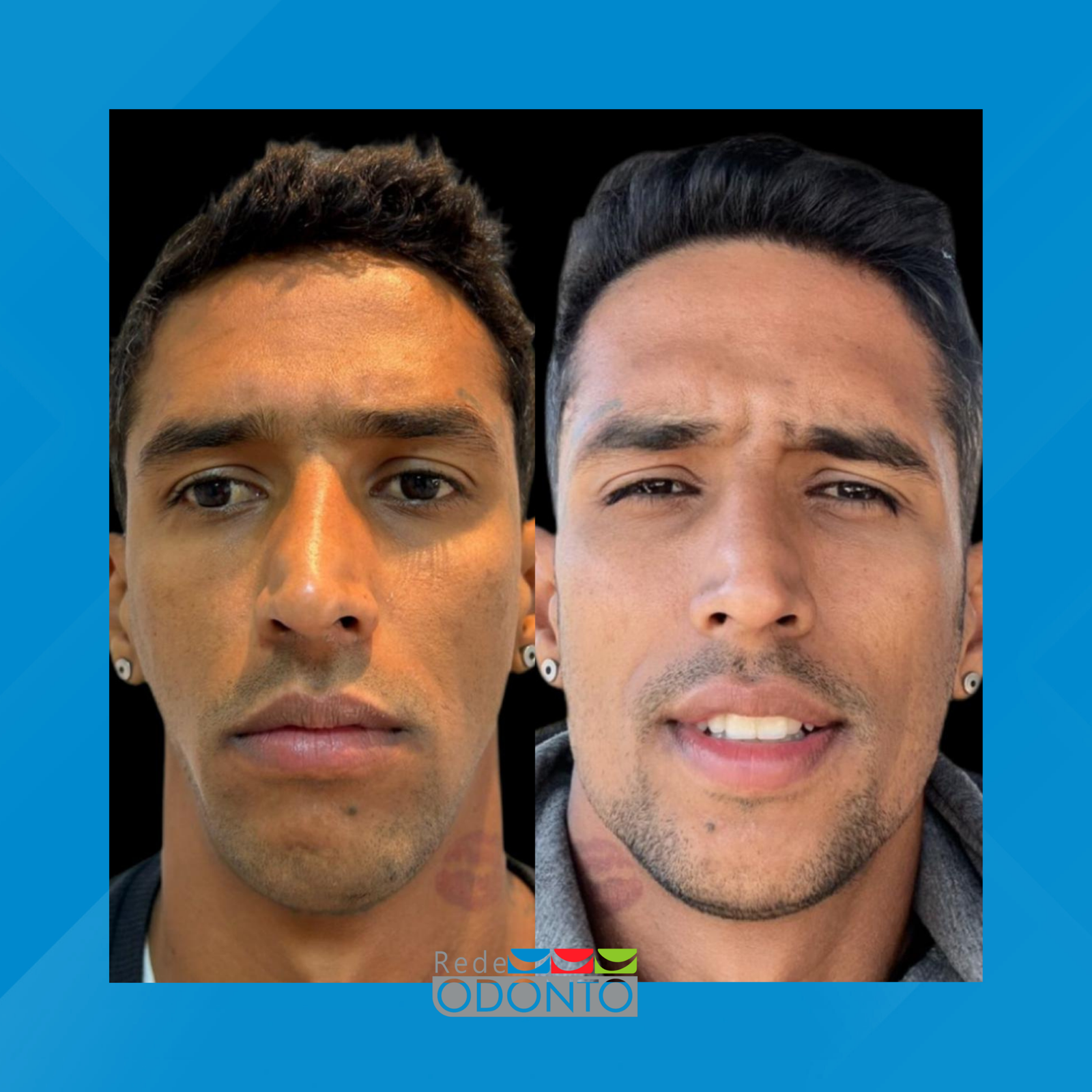 Rede Odonto Cabana. Harmonização Facial. #2.1