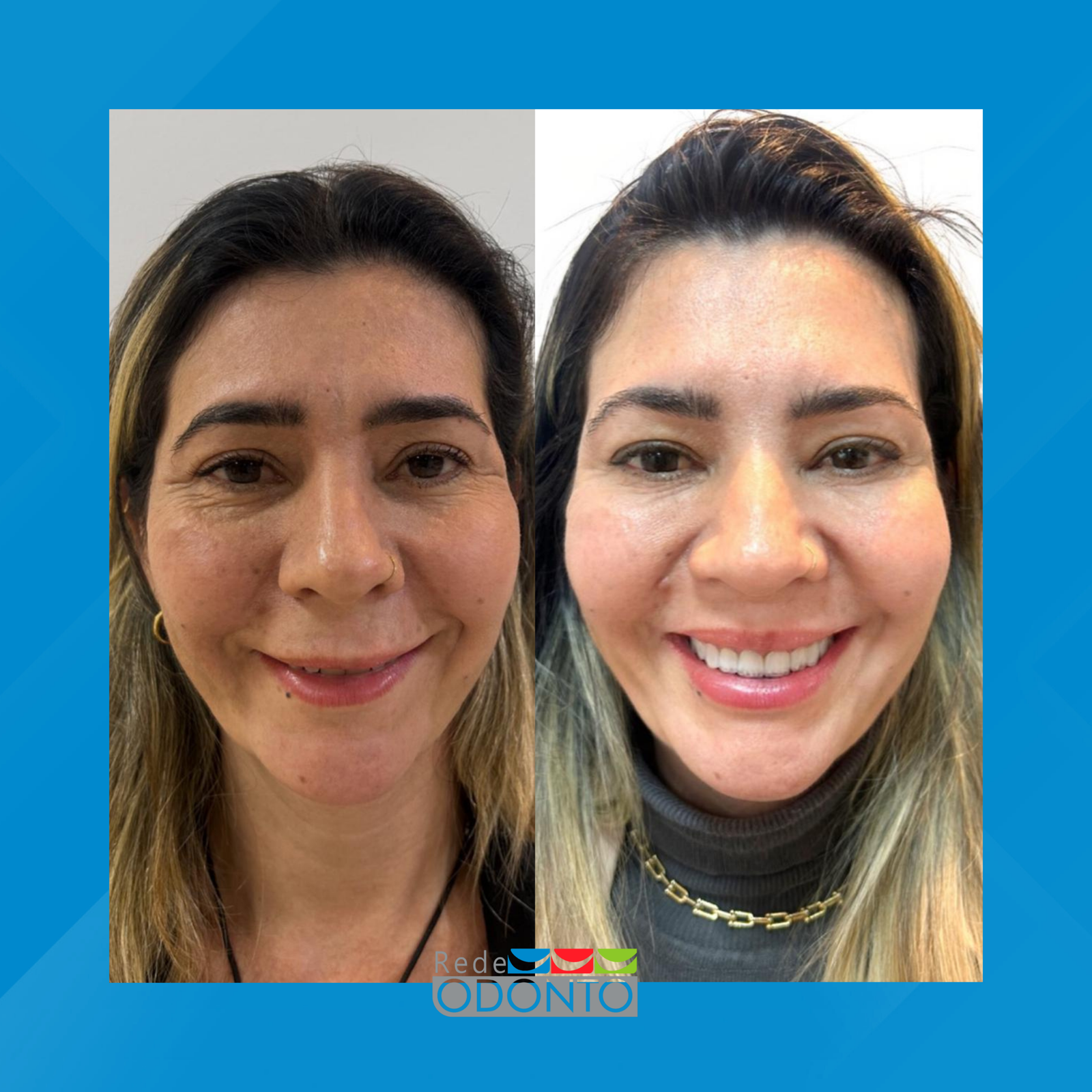 Rede Odonto Cabana. Harmonização Facial. #3.1