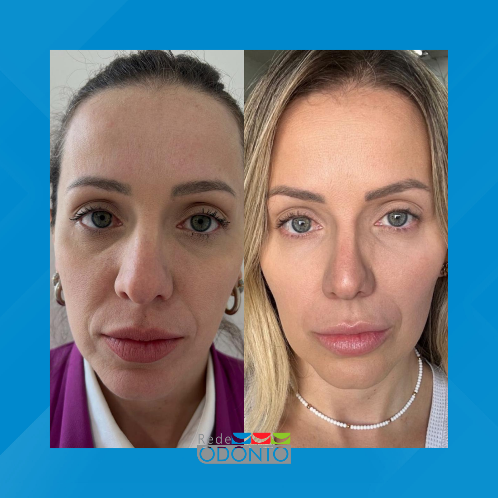 Rede Odonto Cabana. Harmonização Facial. #4.1