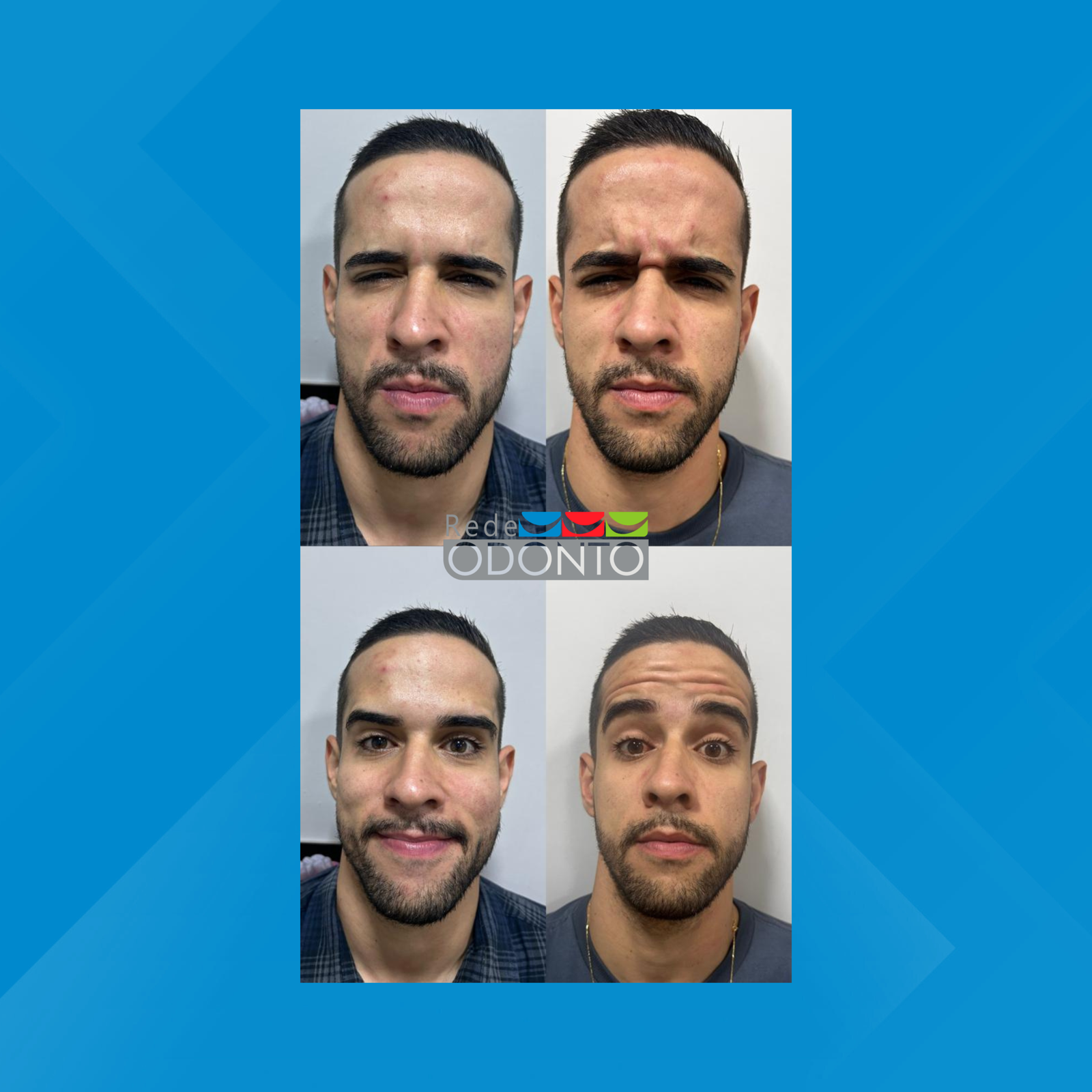 Rede Odonto Cabana. Harmonização Facial. #5.1